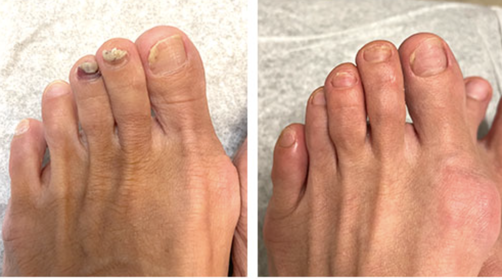 TOE FUNGUS